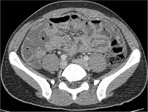 Contrast capture in the peritoneum and intraabdominal fluid in CT abdomen (white arrow).