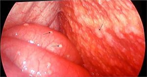 Laparoscopy image with miliary implants throughout the peritoneal cavity and parietal and visceral peritoneum (black arrows).