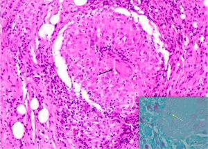 (A) Hematoxiline–eosine stain with necrotizing granulomatous inflammation with multinucleated giant cells (black arrow). (B) Ziehl Neelsen stain with presence of acid–alcohol resistant bacillus (yellow arrow).