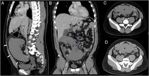 Contrast-enhanced abdominal CT in portal (A–C) and delayed (D) phases. Sagittal (A) and coronal (B) reformatting. Hypogastric mass corresponding to enlarged spleen. Inflammatory changes and peri-splenic fluid (green arrows) can be seen. In the coronal view, torsion of the splenic vessels with abnormal surrounding fat is shown (blue arrow). No significant differences in the enhancement pattern between the portal and delayed phases are observed (asterisk in C and D).