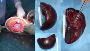 Emergent splenectomy through midline laparotomy (A). The spleen showed an ischaemic appearance and torsion of the pedicle was found. (B–D) Surgical specimen consisting of a congestive and enlarged spleen (B, C) with torsion of its pedicle (D).