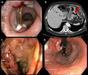 Endoscopic and radiological images of the foreign body and gastrocolic fistula A) Image of the foreign body embedded in the sigmoid colon. B) CT: fistulous path (arrow) between the gastric corpus and the left colon. C) Splenic flexure with ulcerated mucosa and impassable stenosis. D) Raised lesion with depressed centre suggestive of the gastric portion of the gastrocolic fistula.