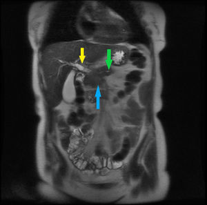 MRI: Irregular, hyperintense mass of 2.5 cm, poorly defined in head of the pancreas (blue arrow) with intra- and extrahepatic bile duct (yellow arrow) and duct of Wirsung (green arrow) dilatation.