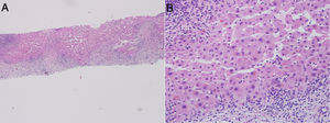 Liver biopsy showing a distorted parenchyma (A) with significant portal interphase infiltration, necrosis and fibrosis in bridges; the intrahepatic bile ducts showed intense obliterative fibrosis (B).