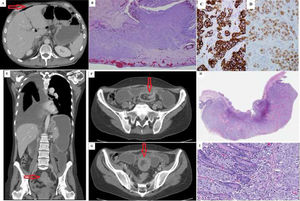 A) Case 1 abdominal CT axial slice: pneumoperitoneum (arrow). B) Case 1 histology: wall of the small intestine infiltrated by the tumour. Infiltration from the peritoneal layer towards the mucosa, in which small tumour nests, ulceration and surface necrosis are observed. C) Case 1 immunohistochemistry. Positivity for cytokeratin 7 in the membrane and cytoplasm in the tumour. D) Case 1 immunohistochemistry. Positive TTF-1 in the infiltrating tumour. E–G) Case 2 abdominal CT: small intestine invagination (arrow). H) Case 2 histology: panoramic view of the ulcerated intestinal wall infiltrated by adenocarcinoma throughout its thickness. I) Case 2 histology: sheet-like growth of the neoplasm, forming solid nests, cells with the presence of intracytoplasmic vacuoles and cell lumina.
