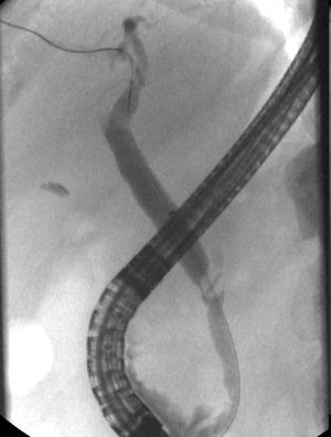 A 10mm×6mm suspected stone with a central oval radiopaque defect in the common hepatic duct.
