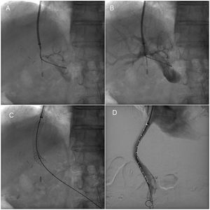 Transjugular intrahepatic portosystemic shunt (TIPS) procedure. (A) Portal venogram after successful puncture from the hepatic vein. (B) Portal venogram after catheter has been advanced into the main portal vein shows normal portal vein bifurcation and intrahepatic branches. (C) Fluoroscopic image demonstrates full deployment of the stent graft. (D) Fluoroscopic image shows flow into the liver and through the stent graft.