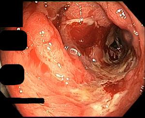 First colonoscopy image: rectal and sigmoid mucosa with oedema, erythema, and wide and deep ulcerations with a fibrinopurulent base.