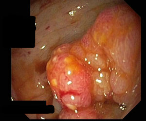 Second colonoscopy image: expansive, bumpy, friable and stenosing lesion in the upper rectum.