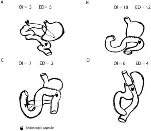 Representation of altered gastrointestinal anatomy due to intestinal surgery: (a) Whipple surgery; (b) Billroth II; (c) Distal gastrectomy; (d) Gastric bypass.