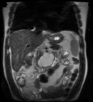 MRI image. Multiloculated macrocystic lesion on the pancreas.