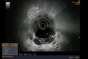 Endoscopic ultrasound image of a pancreatic lymphangioma.
