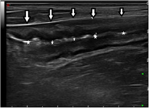 Longitudinal slice of a thickened segment of neoterminal ileum (the arrows indicate the neoterminal ileum and the asterisks indicate the lumen).