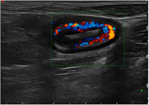 Transverse slice of a segment of terminal ileum with grade 3 Doppler activity.