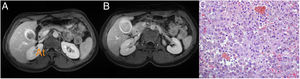 A and B) Magnetic resonance imaging: gallbladder lesion with haemorrhagic content. C) Histology: mononuclear histiocytes with abundant cytoplasm with ceroid pigment, mixed with bile and variable proportions of polymorphonuclear leukocytes, lymphocytes and fibroblasts.