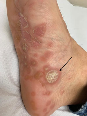 Palmar–plantar involvement in the form of erythematous papules with a hyperkeratotic scaly collarette that may take on a psoriasiform appearance. Larger lesion in the form of localised hyperkeratosis (black arrow).