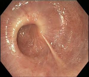 Upper gastrointestinal endoscopy. The lower two thirds of the oesophagus have a curious spiral appearance.
