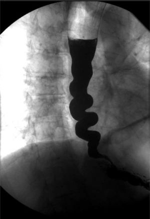 Oesophagogram. The barium column takes on a “corkscrew” shape due to the underlying oesophageal motor disorder.