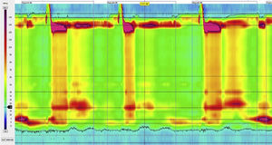 High-resolution manometry (HRM). Elevated mean integrated relaxation pressure (46 mmHg; normal <15) and aperistalsis with pan-pressurisation every time the patient swallowed, suggestive of type 2 achalasia. In addition, overlapping component of non-premature spastic contraction in the distal segment and intermittent oesophageal shortening.