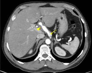 Transverse CT slice at the coeliac trunk: “intimal flap” (arrow) suggestive of coeliac trunk dissection, extending to the hepatic artery, which is encompassed by a lobed hypodense cuff (arrow tip); this may correspond to the thrombosed false lumen.