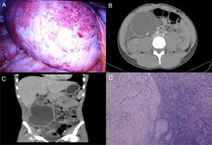 (A) Incidental finding of a mesenteric cyst during laparoscopic surgery for suspected acute appendicitis. (B) Cystic tumour measuring 7.7 cm × 10.3 cm × 3 cm of apparent mesenteric origin in the right flank. (C) Known cystic mass, with increased wall thickness, suggestive of a complicated cystic lymphangioma. (D) Histology slice viewed under a microscope of the concentric cyst wall with inflammatory infiltrate.
