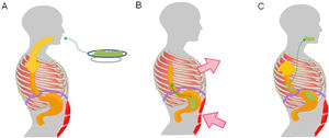 Pathophysiological mechanism of rumination. Food intake initiates a conditioned response, which consists of involuntary contraction of the muscles of the abdominal wall (A), an increase in intra-abdominal pressure and contraction of the intercostal muscles (thoracic suction) (B), associated with relaxation of the diaphragm, which enables reflux of recently ingested foods from the stomach to the mouth (C).