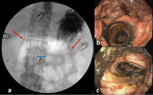 (a) Fluoroscopy during endoscopic ultrasound guided gastrojejunostomy (right red arrow) in a patient with previous uncovered duodenal self-expandable metal stent (left red arrow) and endovascular stent (blue arrow). (b) Endoscopic image of the lumen-apposing metal stent. (c) Ulcerative jejunitis.