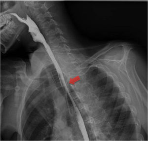 Image from an oesophageal transit study with Gastrografin® revealing the passage of contrast through the oesophagus, with no evidence of leakage.