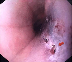 Upper gastrointestinal endoscopy image showing whitish oesophageal mucosa with haemorrhagic suffusion and two orifices in the mucosa.