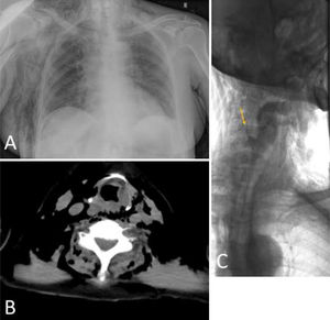(A) Chest X-ray demonstrating exuberant thoraco-abdominal and neck emphysema. Note lack of free abdominal and/or retroperitoneal air. (B) CT scans likewise illustrating diffuse neck emphysema suggestive of hypopharyngeal perforation. (C) Limited contrast swallow using water-soluble gastrografin confirmative of a small pyriform sinus perforation.