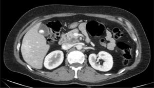 Abdominal CT scan showing a hypotensive pancreatic mass in the pancreatic head with solid cystic content and small calcifications inside.