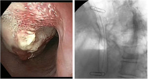A. Endoscopy. B. Implantation of a self-expanding metal oesophageal prosthesis.