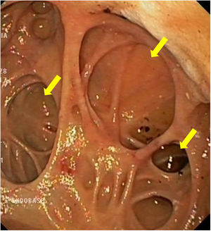 Duodenal bulb deformed by reason of multiple diverticula with remnants of recent bleeding, but without active bleeding (yellow arrows).