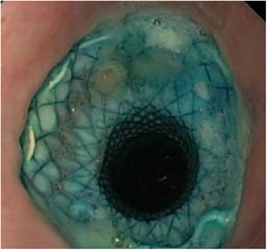 Endoscopic visualisation of the placed FCSEMS.
