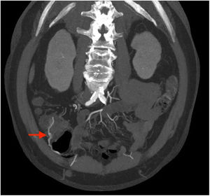 Abdominal and pelvic CT (oblique slice).