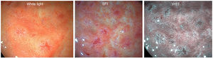 Papules with a central depression.4 In addition, the SFI modality shows a violet hue reminiscent of the lavender colour sign.5