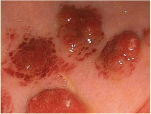 Endoscopic imaging showing raised violaceous nodules in the gastric body.
