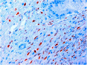 HHV-8 detected by immunohistochemistry, with positivity for fusiform tumour cell nuclei appearing in brown.