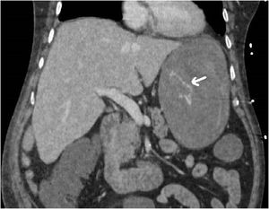CT showing gastric dilation with bloody contents and linear serpiginous imaging of contrast extravasation consistent with active bleeding (indicated with an arrow).