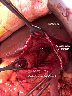 Anterior gastrostomy exposing a longitudinal gastric ulcer due to pressure from a nasogastric tube in the lesser curvature, causing massive upper gastrointestinal bleeding (marked between white dots).
