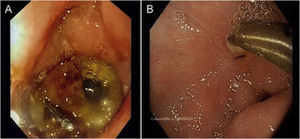 A) Partially fibrinous ulcer in the duodenal bulb, with a visible pulsatile vessel and a haemostasis clip. B) Follow-up endoscopy at 12 weeks: clear outflow of bile through the fistula opening on a fibrinous duodenal ulcer.