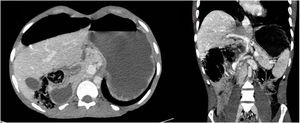 Axial (left) and coronal (right) CT imaging showing the liver in the right hypochondrium and gastric dilatation.