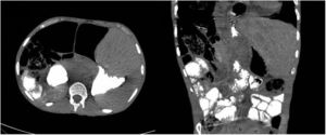 Axial (left) and coronal (right) CT imaging showing the location of the liver in the left hypochondrium and the passage of oral contrast to the small bowel loops, past the obstruction.