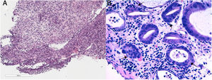 Haematoxylin–eosin staining: Intestinal mucosa with extensive erosion and ulceration of the surface epithelium accompanied by mixed inflammatory infiltration extending through the lamina propria (A, 4× magnification), showing much evidence of cell apoptosis at the bottom of the crypts (arrows) (B, 20× magnification).