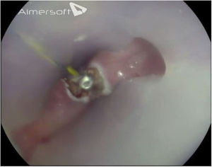 Endoscopic diverticulotomy. Placement of haemostatic clip.