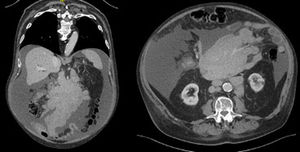 Abdominal CT scan. Coronal and transverse plane, respectively.