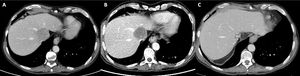 (A) Pre-treatment index CT scan. HCC closely related to the middle and left suprahepatic veins. (B) Post-TACE PET-CT scan. Absence of metabolic uptake in the HCC with slightly hypermetabolic margins. (C) Post-surgical follow-up CT after one and a half months. Vascular permeability in the suprahepatic veins, with no residual tumour.