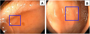 Detection of high-grade dysplasia in a patient with Barrett