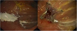 Gastrojejunal anastomotic leakage treated by endoscopic-White-Test and over-the-scope clip. Detection of the orifice at the level of the gastro-enteric anastomosis due to a “jet” leak of the white dye, and sealed with an over-the-scope clip.