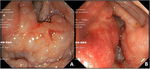 Colonoscopy with multiple cystic images of varied sizes in the descending colon (A), with erythematous overlying mucosa (B).